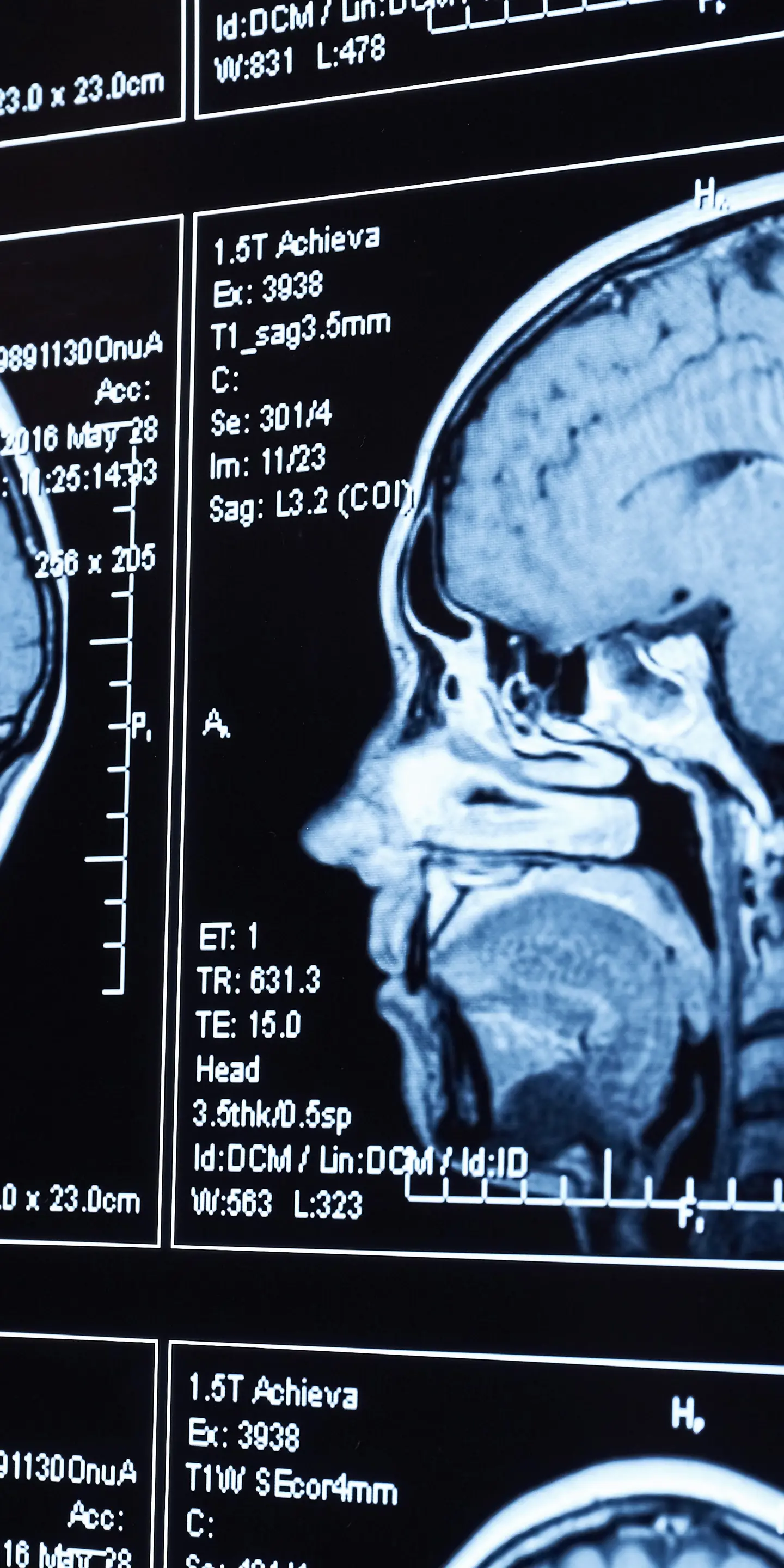 MRI Head Scan